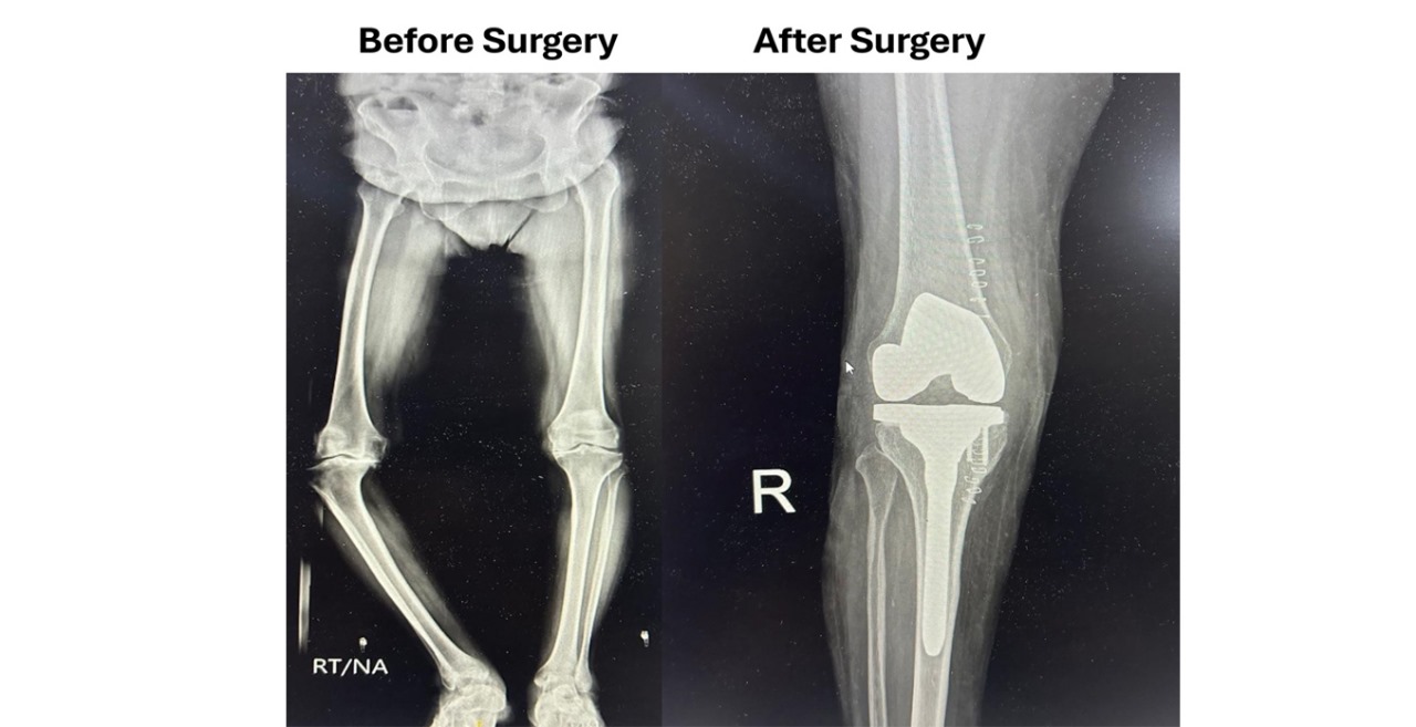 Hip and Knee Replacement in South Delhi